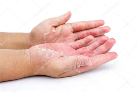 Manos Secas Cáscara Dermatitis De Contacto Infecciones Fúngicas 2022