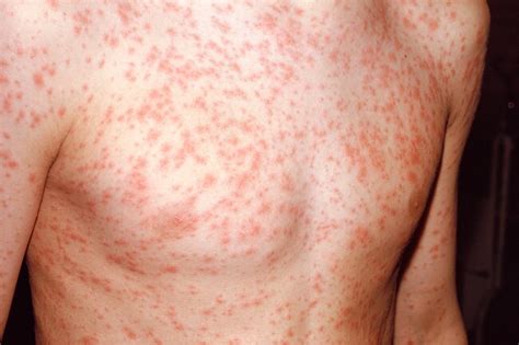 Pictures Of Viral Rashes In Adults And Children