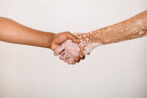 All You Need To Know About Vitiligo Doha News Qatar