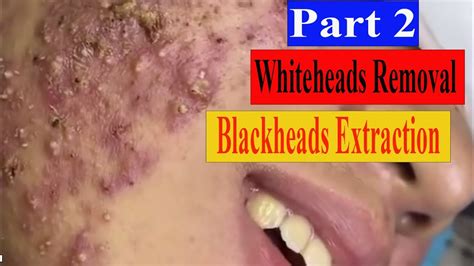 Blackheads And Milia Big Cystic Acne Blackheads Extraction Whiteheads