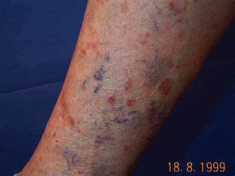 lichen planus skin rash