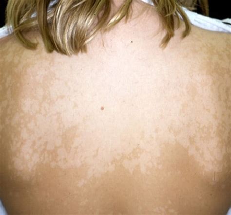 Albums 96 Pictures Pictures Of Tinea Versicolor On Face Updated