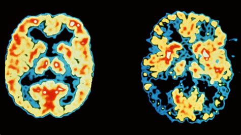 Dementia Now Leading Cause Of Death Bbc News