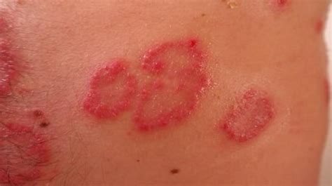 Psoriasis Tied To Higher Risk Of Serious Liver Disease