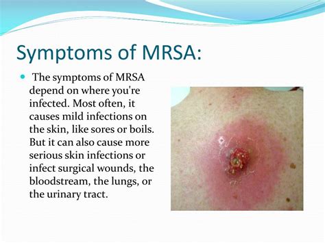 Ppt Methicillin Resistant Staphylococcus Aureus Mrsa Powerpoint