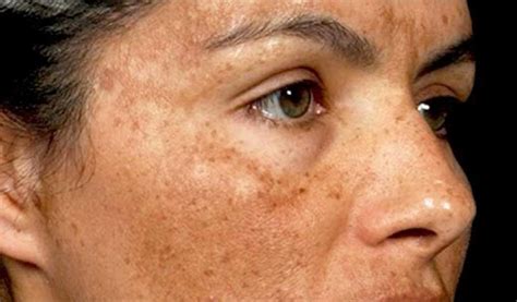 5 Tricks To Get Rid Of Dark Spots And Hyperpigmentation By Sarah Healy