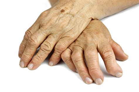 Arthritic Hands Istockgetty Images Rheumatoid Arthritis