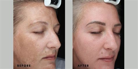 New Goodbye Dark Patches Chloasma And Melasma Depigmentation