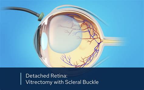 Scleral Buckle And Retina Repair Retinal Consultants Medical Group