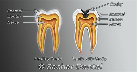 Dentist Nyc Dental Cavity Fillings Sachar Dental Nyc