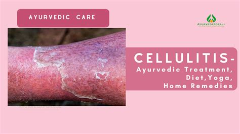 Ayurvedaforall Uk Ayurvedic Treatment Of Cellulitis