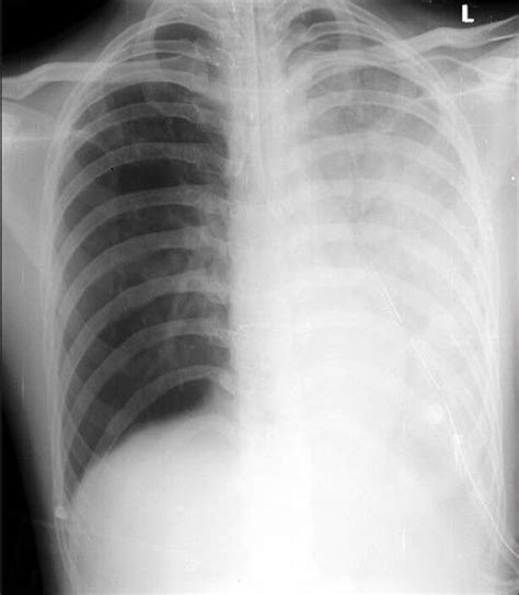 Chest Radiograph Showing Left Sided Re Expansion Pulmonary Oedema