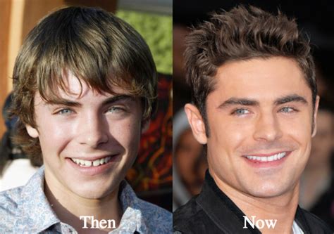 Zac efron has never admitted to having a nose job. Zac Efron Plastic Surgery Before and After Photos