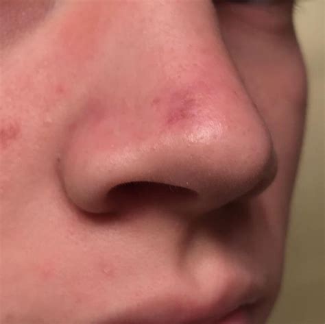 Acne About A Year Ago I Had A Blind Pimple On My Nose And I Popped It