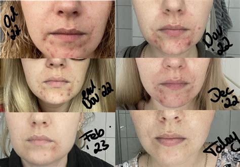Before And After Perioral Dermatitis And Hormonal Acne Oct 2022 Till