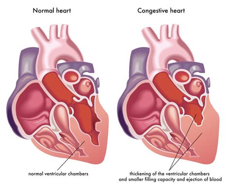 Congestive Heart Failure Chf Recovery Nutrimedical