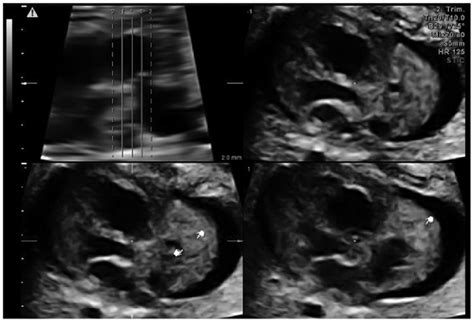 Tomographic Ultrasound Imaging Results Demonstrating A Solitary Tumor