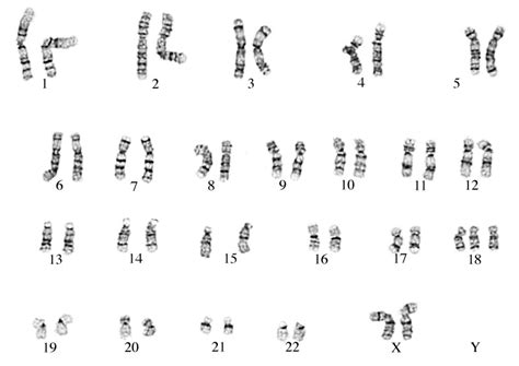 Karyotype With Edwards Syndrome MCQPlus