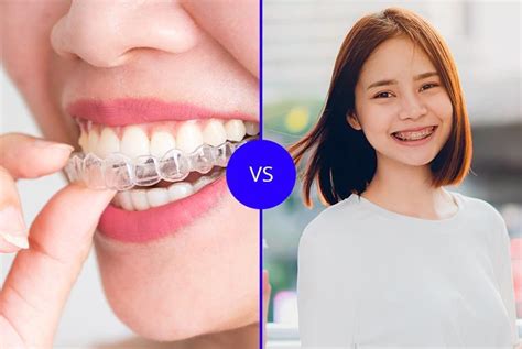 Difference Invisalign Vs Fixed Braces My Braces Clinic