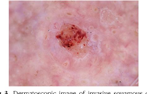 Actinic Keratosis Squamous Cell Carcinoma