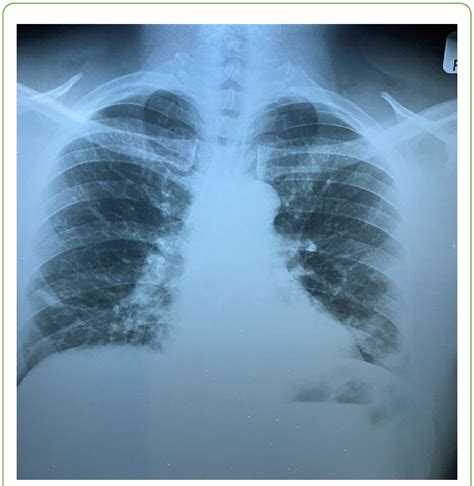 Pa View Chest Radiograph Showing Bilateral Peripheral Opacities And