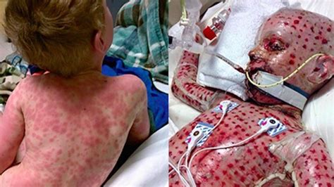 Residents and fellows contest rules | international ophthalmologists contest rules. A little boy suffering from Stevens-Johnson Syndrome (SJS ...