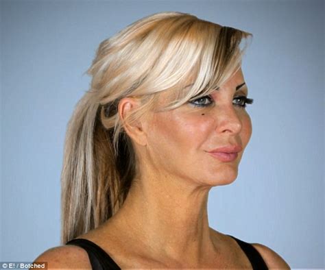 Human Barbie Sarah Burge Begs Botched Doctors For A Face And Hand