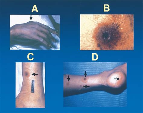 Metastatic Fusarial Skin Lesions Tend To Evolve From A Subcutaneous