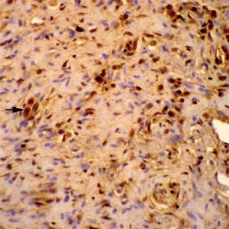 Squamous Cells Carcinoma Well Differentiated Keratinizing With