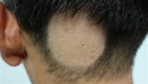 Alopecia areata is a common autoimmune skin disease, causing hair loss on the scalp, face and sometimes on other areas of the body. Alopécia areata | Atlas da Saúde