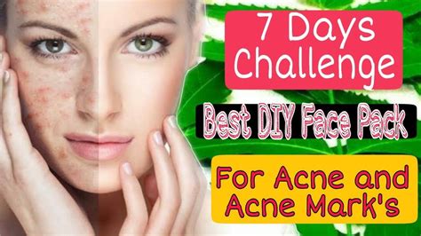 7 Days Challenge Acne Face Mask Diy Treatment Of Acne And Acne Scars