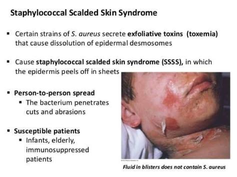 Staphylococcal Scalded Skin Syndrome Nurseinfo