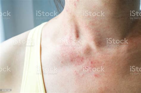 Young Woman Has Skin Rash Itch On Neck Stock Photo Download Image Now