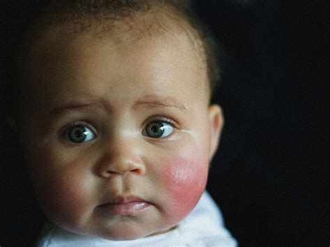 Rosy Cheeks In A Baby Causes And Treatments