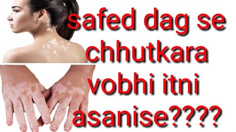 How To Cure Vitiligo Fastsafed Dag Ka Ilajmayurithakur Youtube