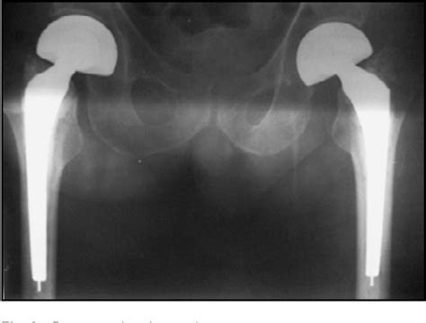 Figure 1 From Bilateral Simultaneous Femoral Neck Fractures Secondary