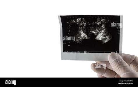 Ultrasound Of The Prostate On An Isolated White Background The Doctor