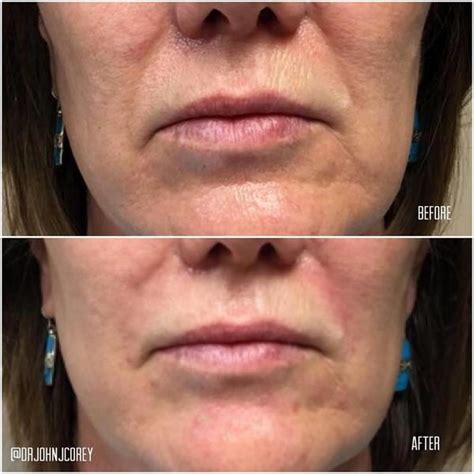 Before And After Photos Of Nasolabial Folds And Above The Chin Using 1