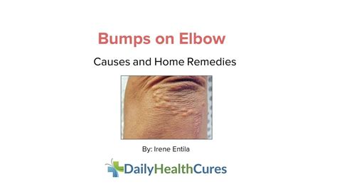 Cluster Of Bumps On Elbow