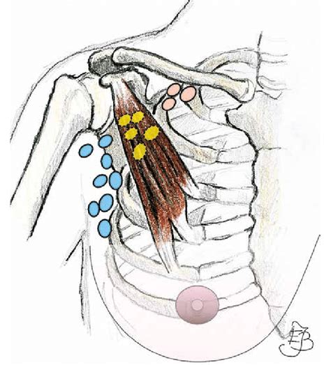 Three Anatomical Levels Of Axillary Lymph Nodes Level I