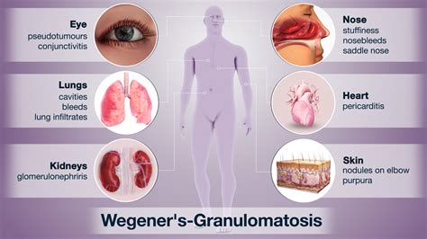 Wegner S Granulomatosis Shown Explained Using Medical Animation Still