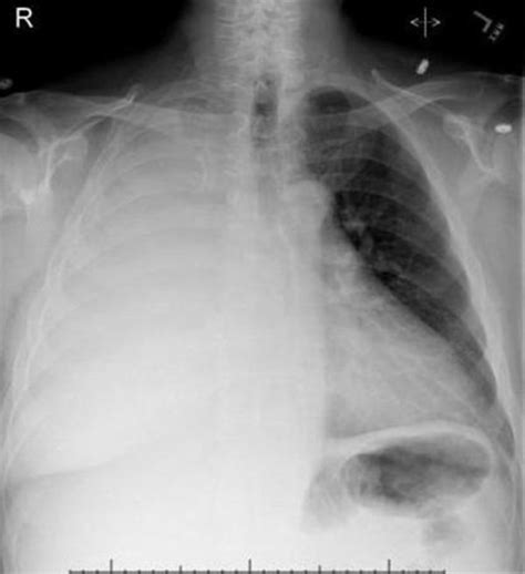 Chest X Ray Showing Right Sided Pleural Effusion Download Scientific