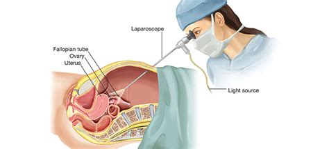 What To Consider Before Undergoing Laparoscopic Surgery Neoalta