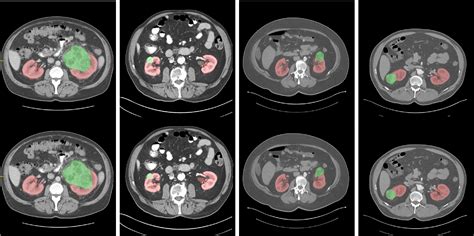 Ai In Medical Imaging The Kidney Tumor Segmentation Challenge