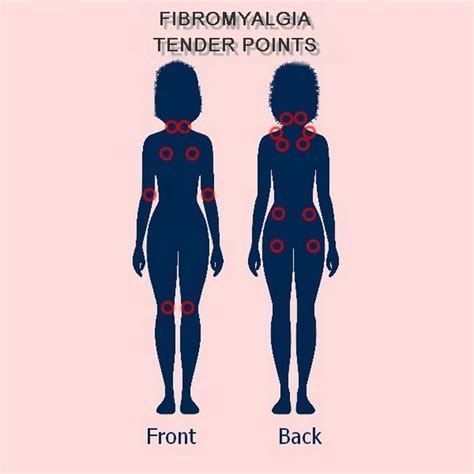 Fibromyalgia Pain My Fibromyalgia Cure