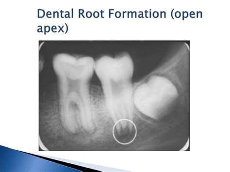 PPT EO 005 06 Normal Intraoral Radiographic Anatomy PowerPoint