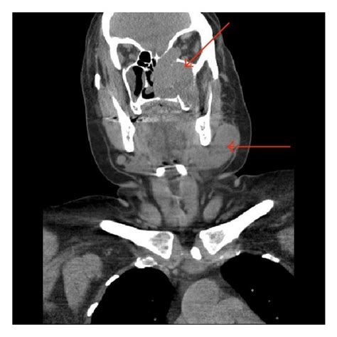 A Axial B Coronal And C Sagittal Ct Scan Of The Neck