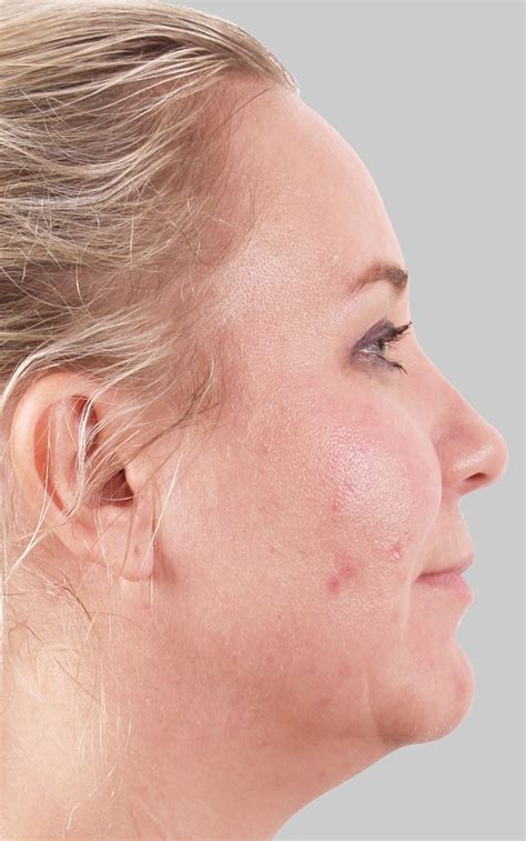 Skin Tightening And Body Shaping Exilis Strimling Dermatology Laser