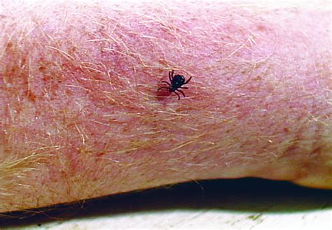 Tick Borne Relapsing Fever Clinical Manifestations Diagnosis