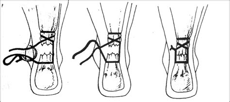 Achilles Tendon Tear Rupture Injury Treatment And Recovery